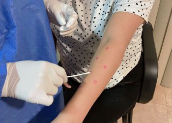 LA TOTALIDAD DE CASOS CONFIRMADOS POR MPOX EN BCS CURSAN LA ENFERMEDAD SIN COMPLICACIONES